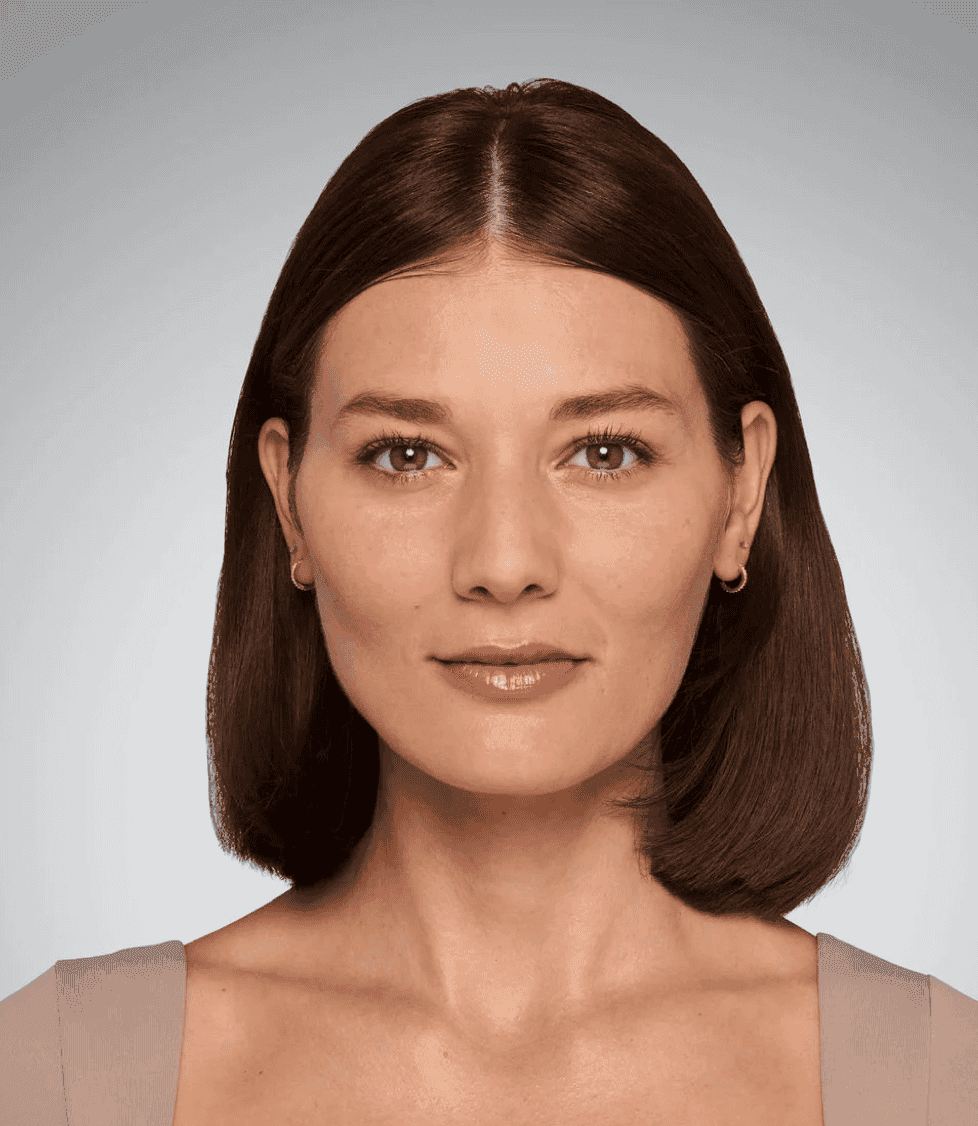 After full facial balancing with dermal fillers