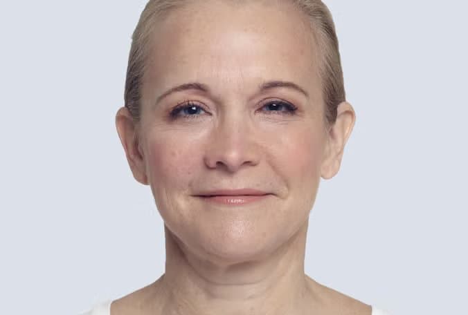 Patient after dermal filler treatment