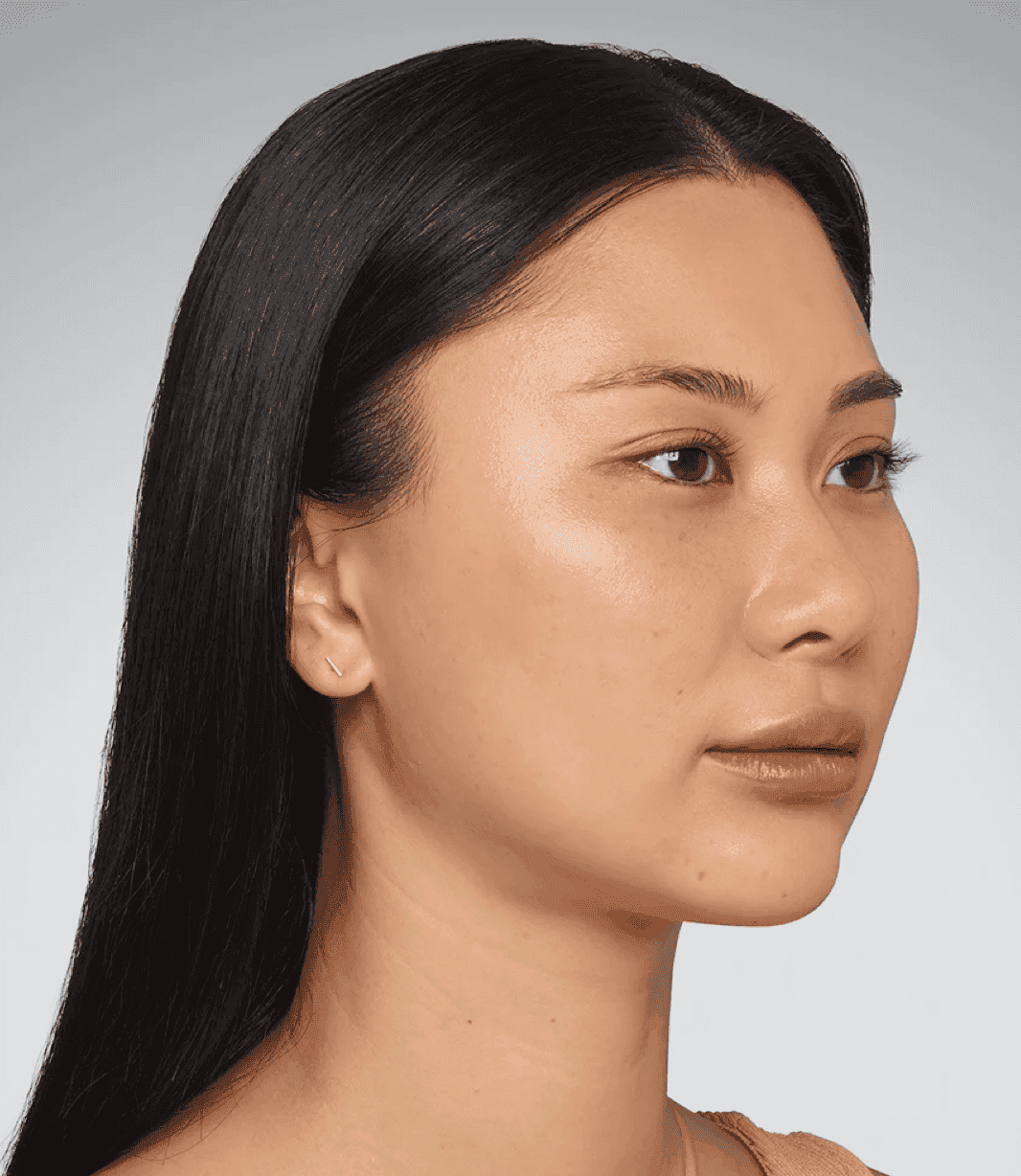 After Sculptra treatment