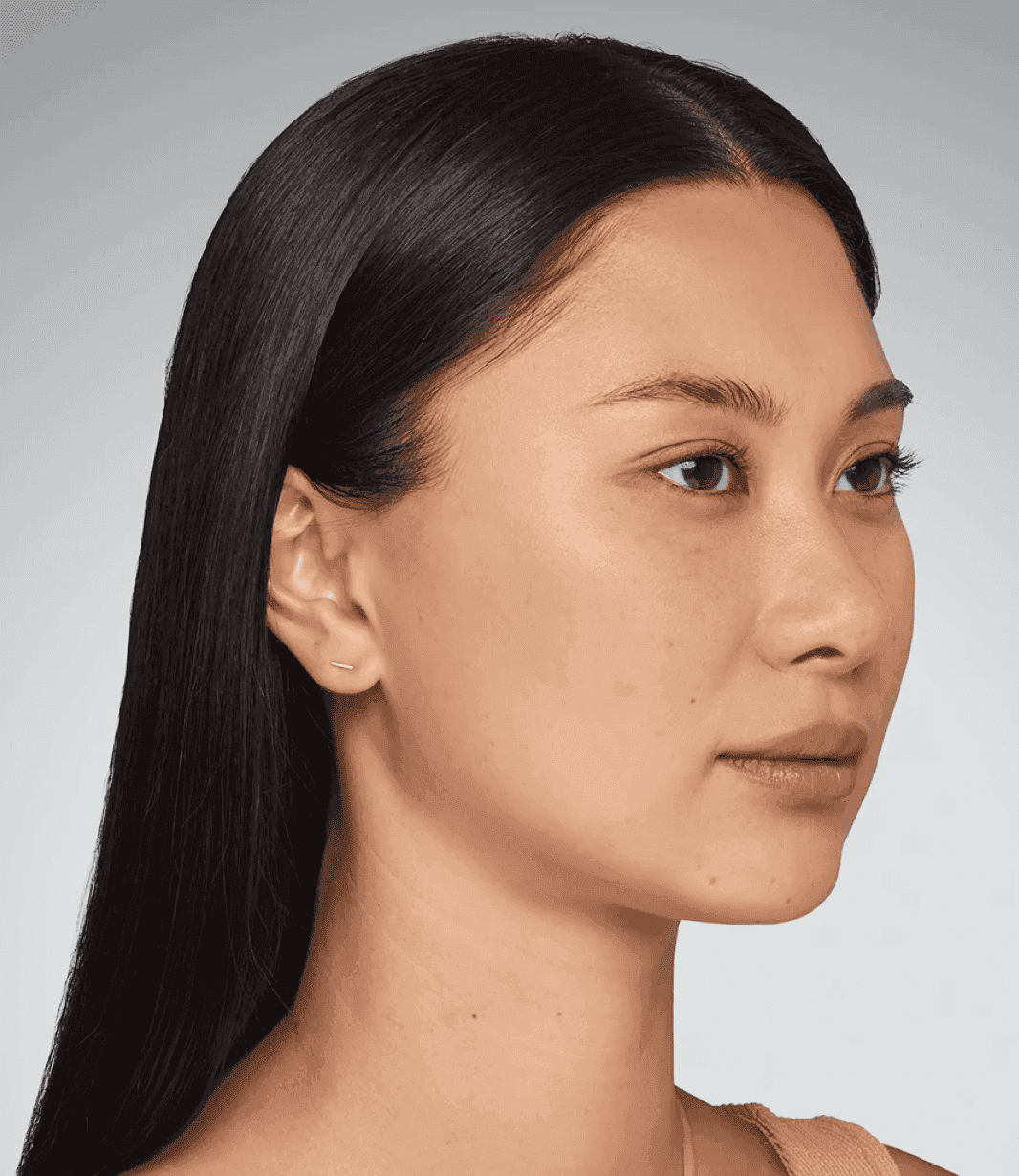 Before Sculptra treatment