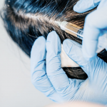 prp staten island microneedling staten island