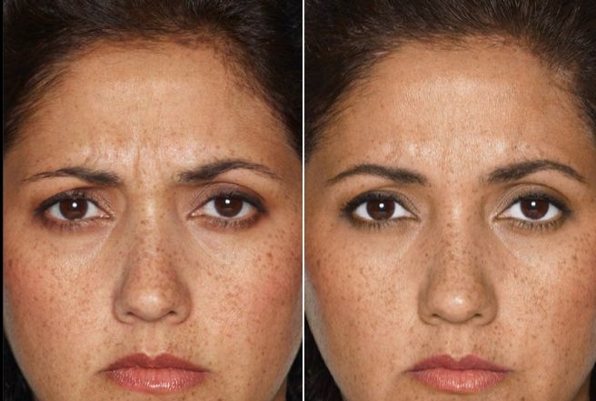 botox before and after botox staten island best botox staten island