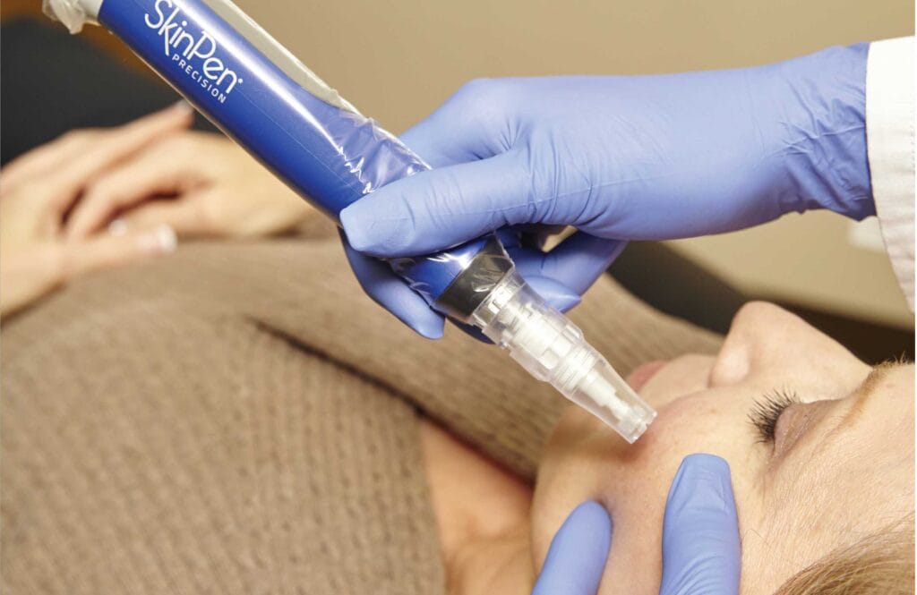 skin pen microneedling staten island